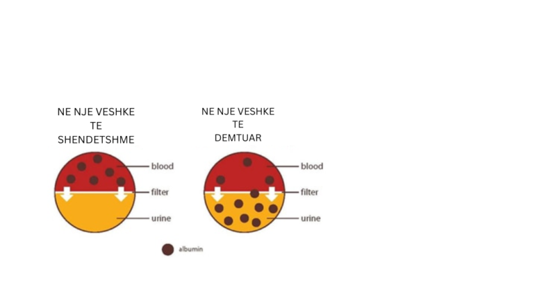 ALBUMINURIA(Prezenca e albumines ne urine)