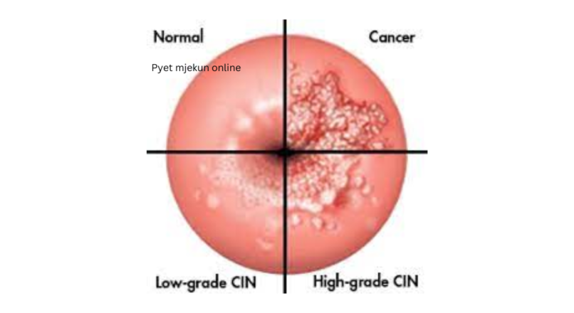 KANCERI I ENDOMETRIT