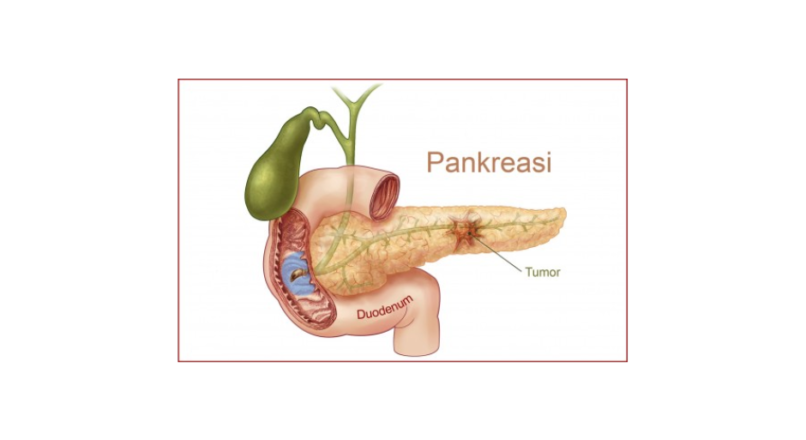 KANCERI PANKREATIK