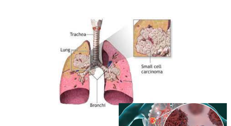 KANCERI PULMONAR